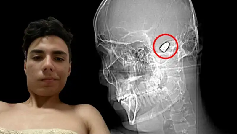 Kafasında Patlamaya Hazır Bomba Taşıyan İnsan: Hayatta Kalabilme Mücadelesi